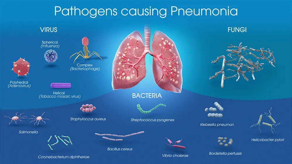 Pathogens causing Pneumonia Pathogens causing Pneumonia
