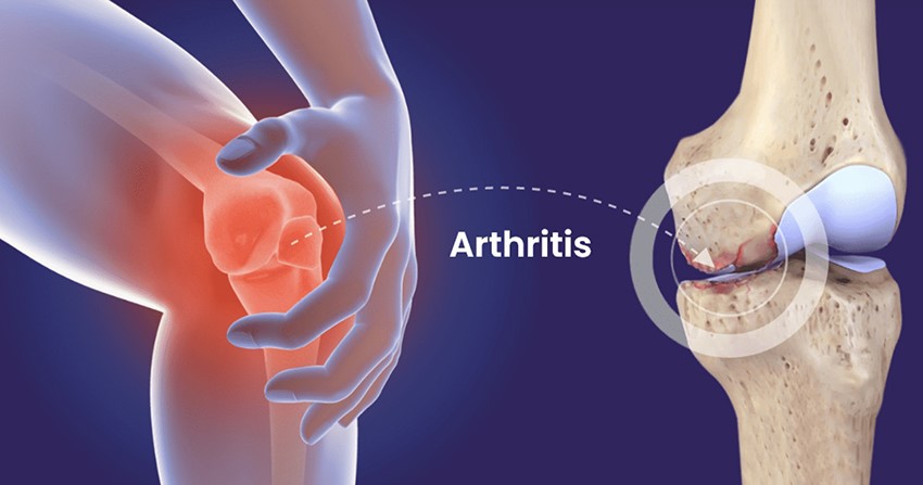 Arthritis Arthritis